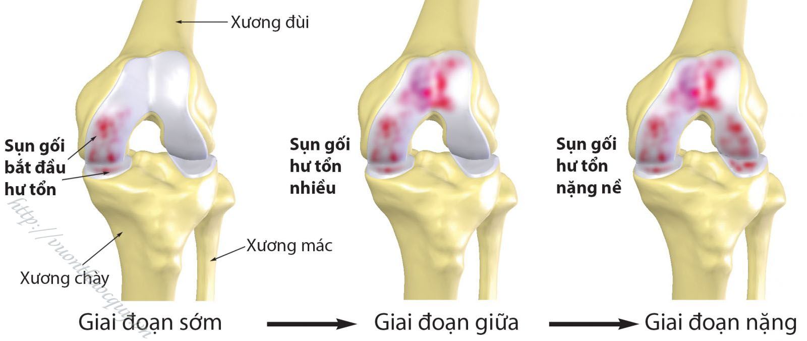 Bệnh Viêm Xương Khớp Là Gì ? | Vườn Thuốc Quý