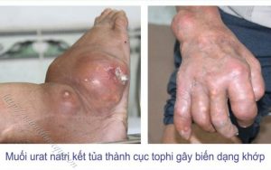 biến chứng của bệnh gout