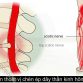 Bệnh Thoát Vị Đĩa Đệm là do tình trạng nhân nhầy đĩa đệm cột sống thoát ra khỏi vị trí bình thường trong vòng sợi chèn ép vào ống sống...